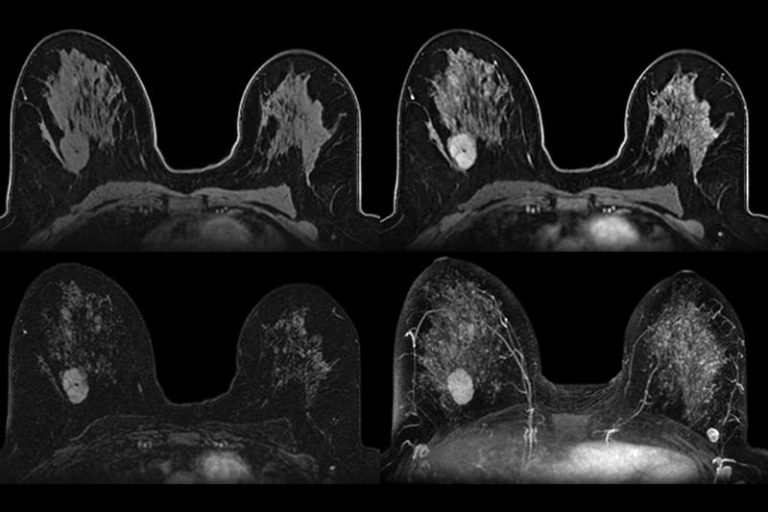 higher-rate-of-breast-cancer-detected-with-mri-tdnews